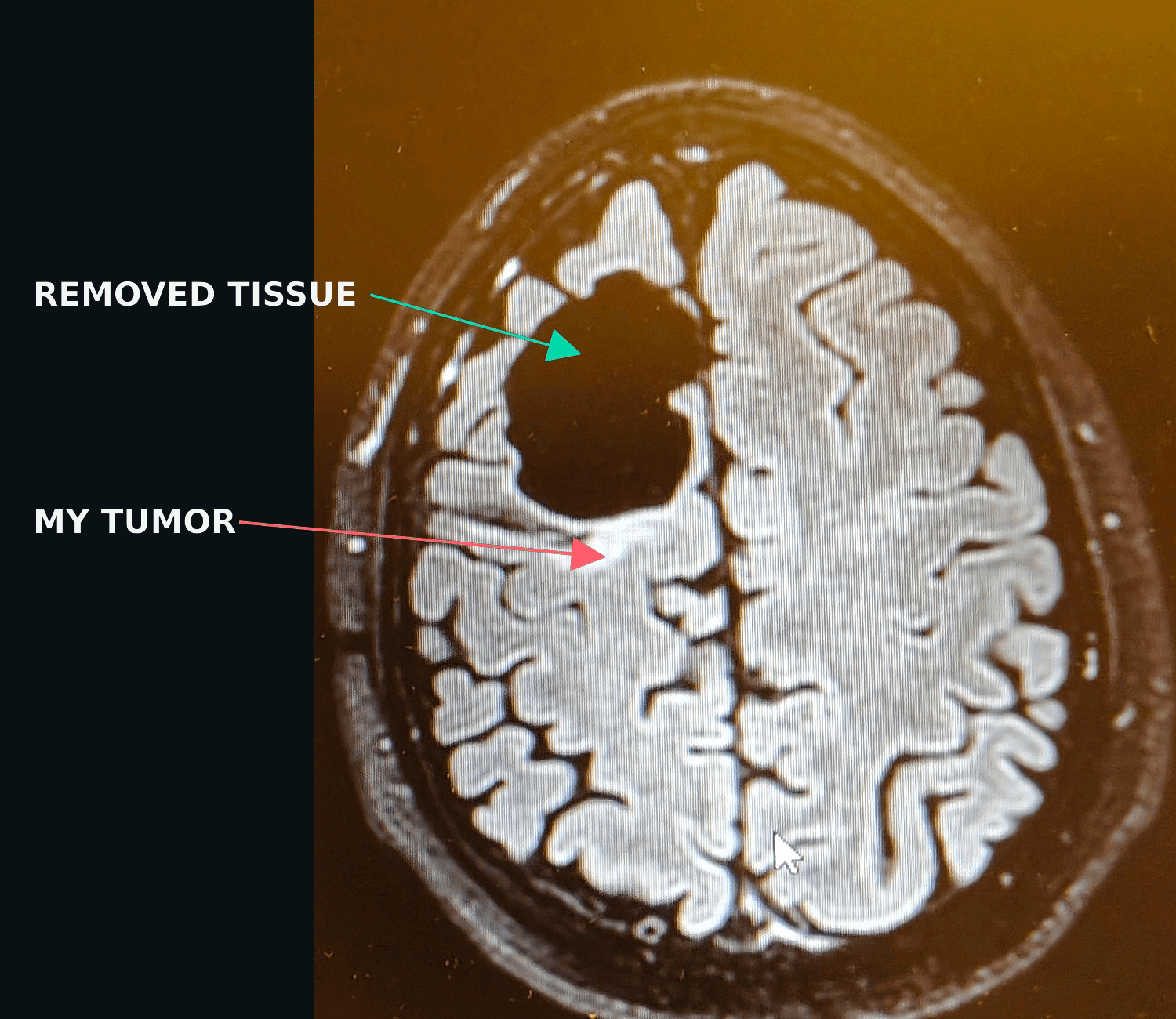 Annotated MRI image with labels identifying removed tissue and Michael's tumor.
